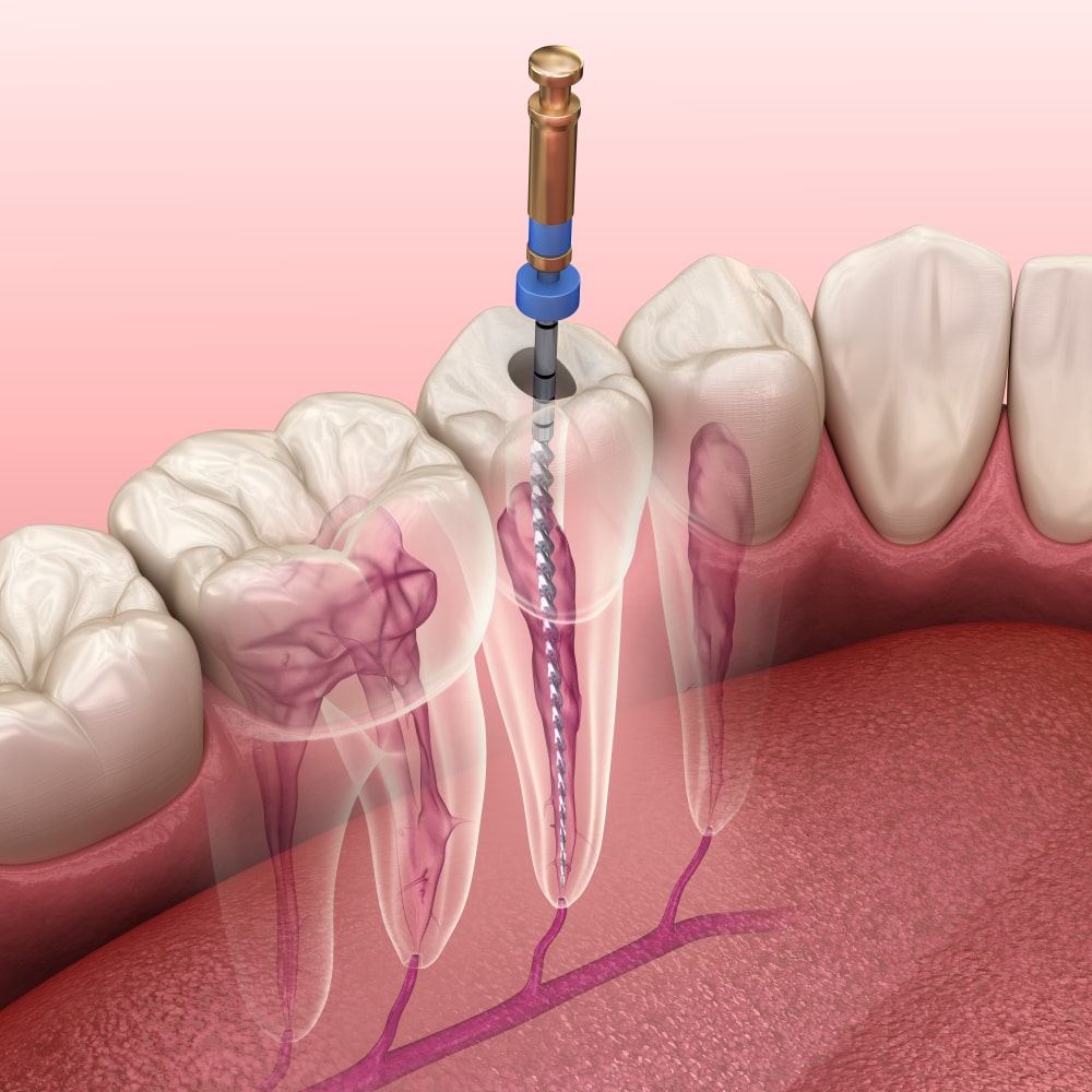 Dental laser in sivananda colony